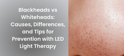 Blackheads vs Whiteheads: Causes, Differences, and Tips for Prevention with Led Light Therapy