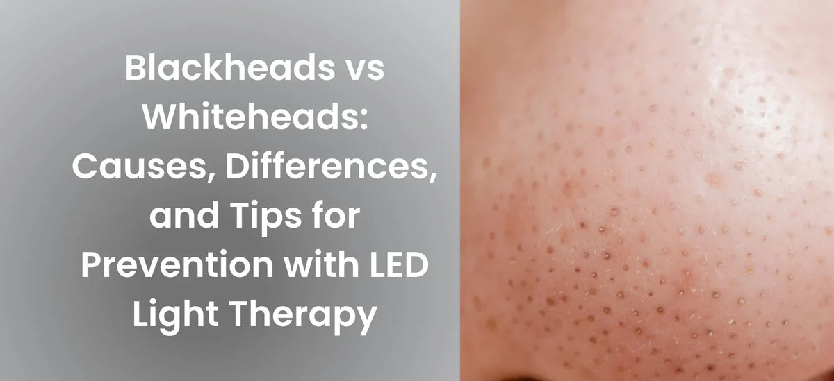 Close-up of skin with blackheads, accompanied by text reading "Blackheads vs Whiteheads: Causes, Differences, and Tips for Prevention with LED Light Therapy.