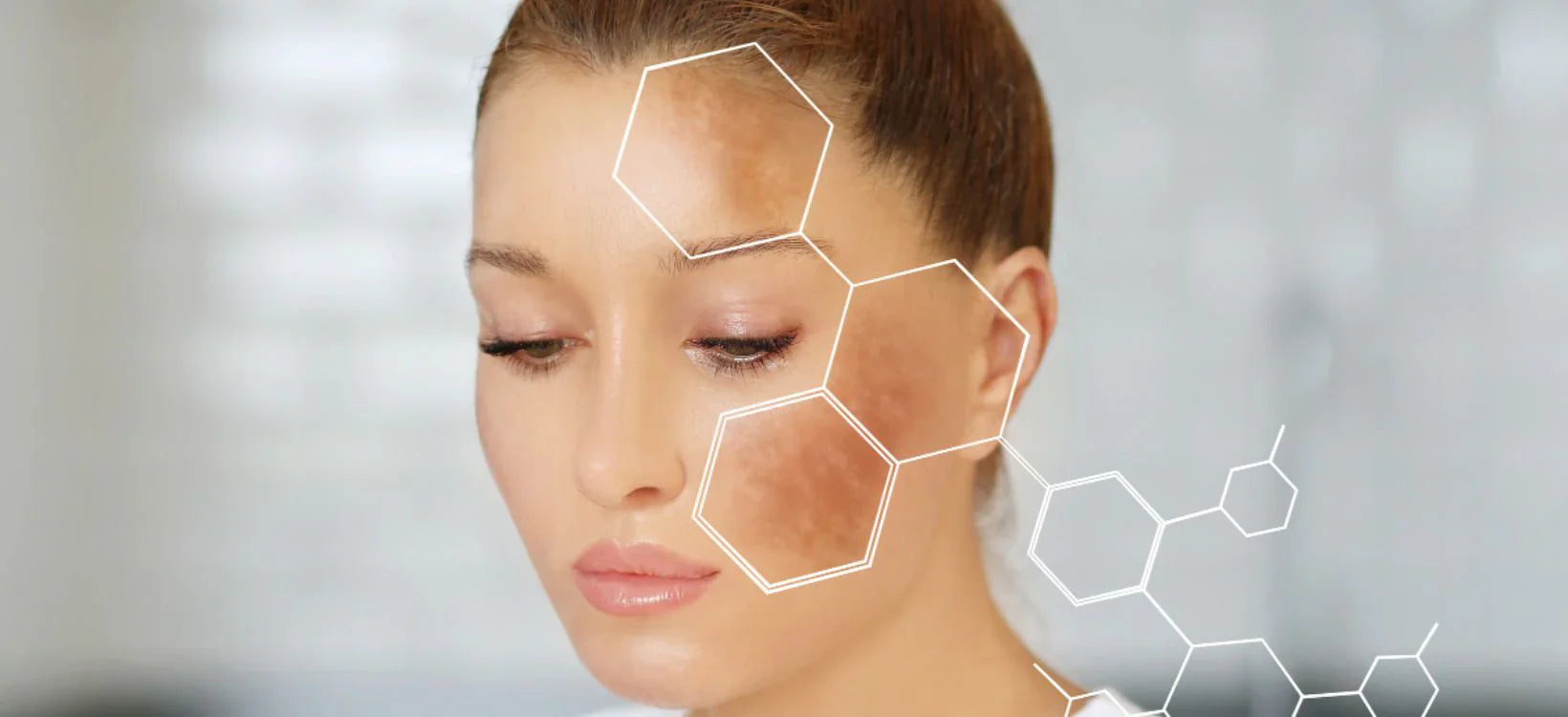 Close-up of woman with sunspots on her cheek highlighted by hexagonal patterns.