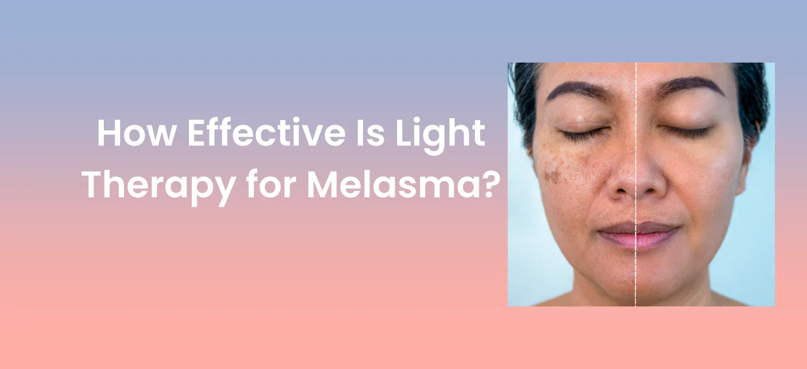 Before and after results of light therapy treatment for melasma on a woman's face, illustrating the effectiveness of skincare solutions for hyperpigmentation.