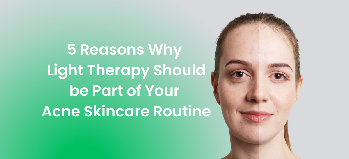 A woman showing a before-and-after acne treatment comparison with text reading "5 ReasoWhy Light Therapy Should be Part of Your Acne Skincare Routine.