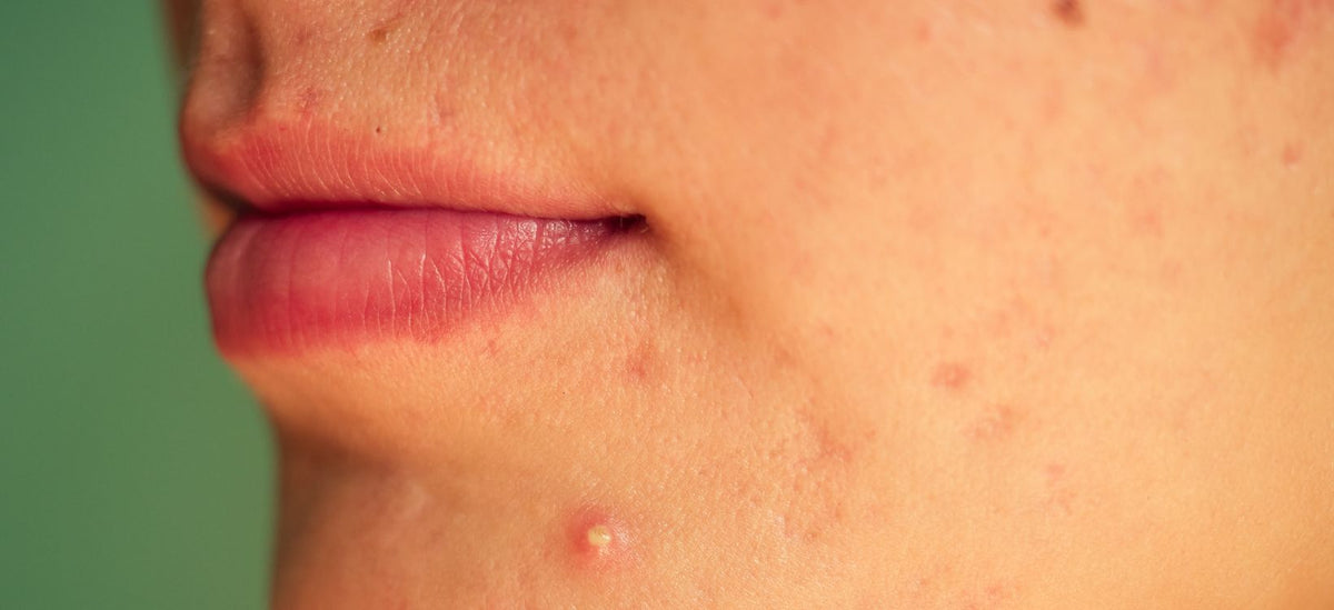 Transforming Textured Skin: The Impact of LED Treatments