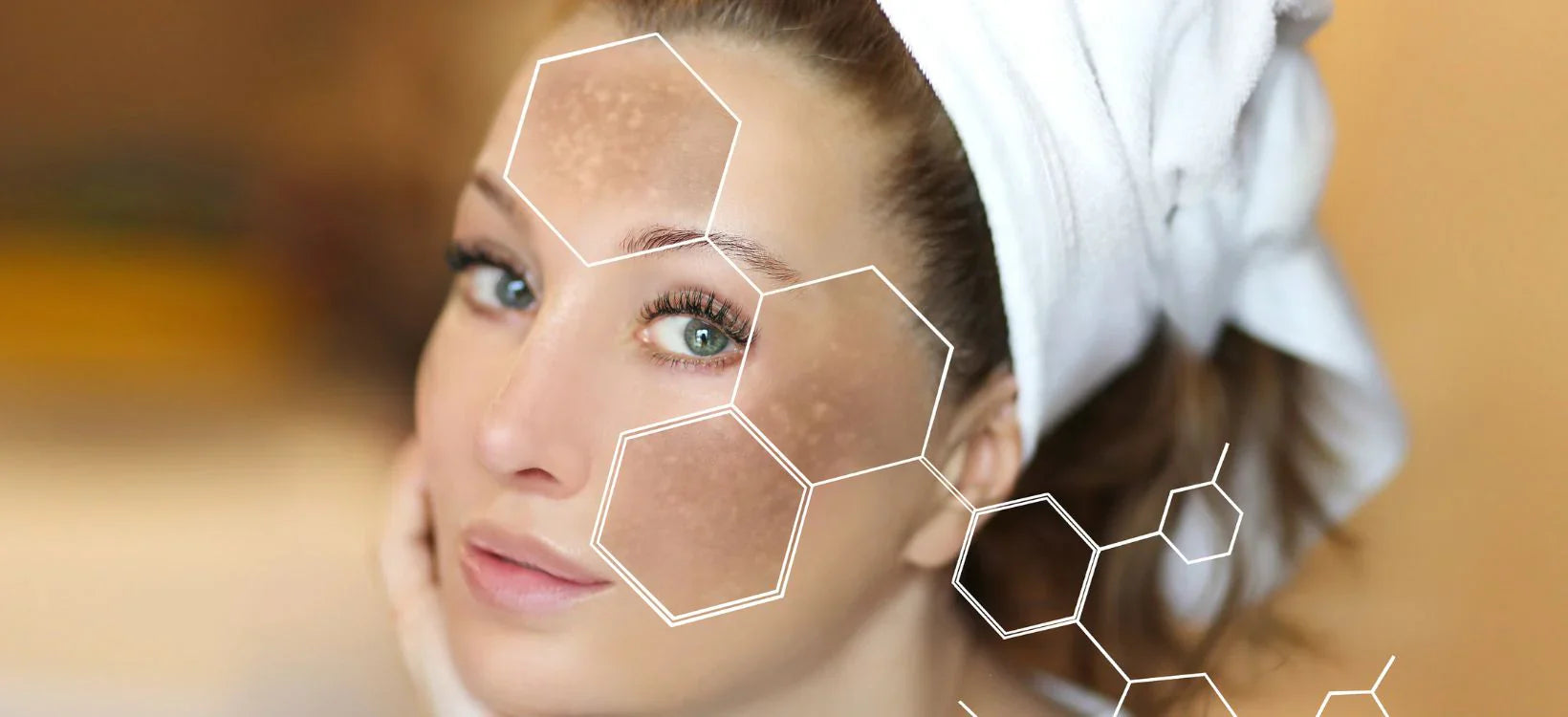 Close-up of a woman's face with hyperpigmentation highlighted on her cheeks and forehead, wearing a white towel wrap on her head, illustrating skincare concerns and treatment focus areas.