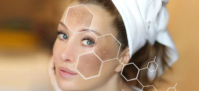 Light Therapy for Hyperpigmentation