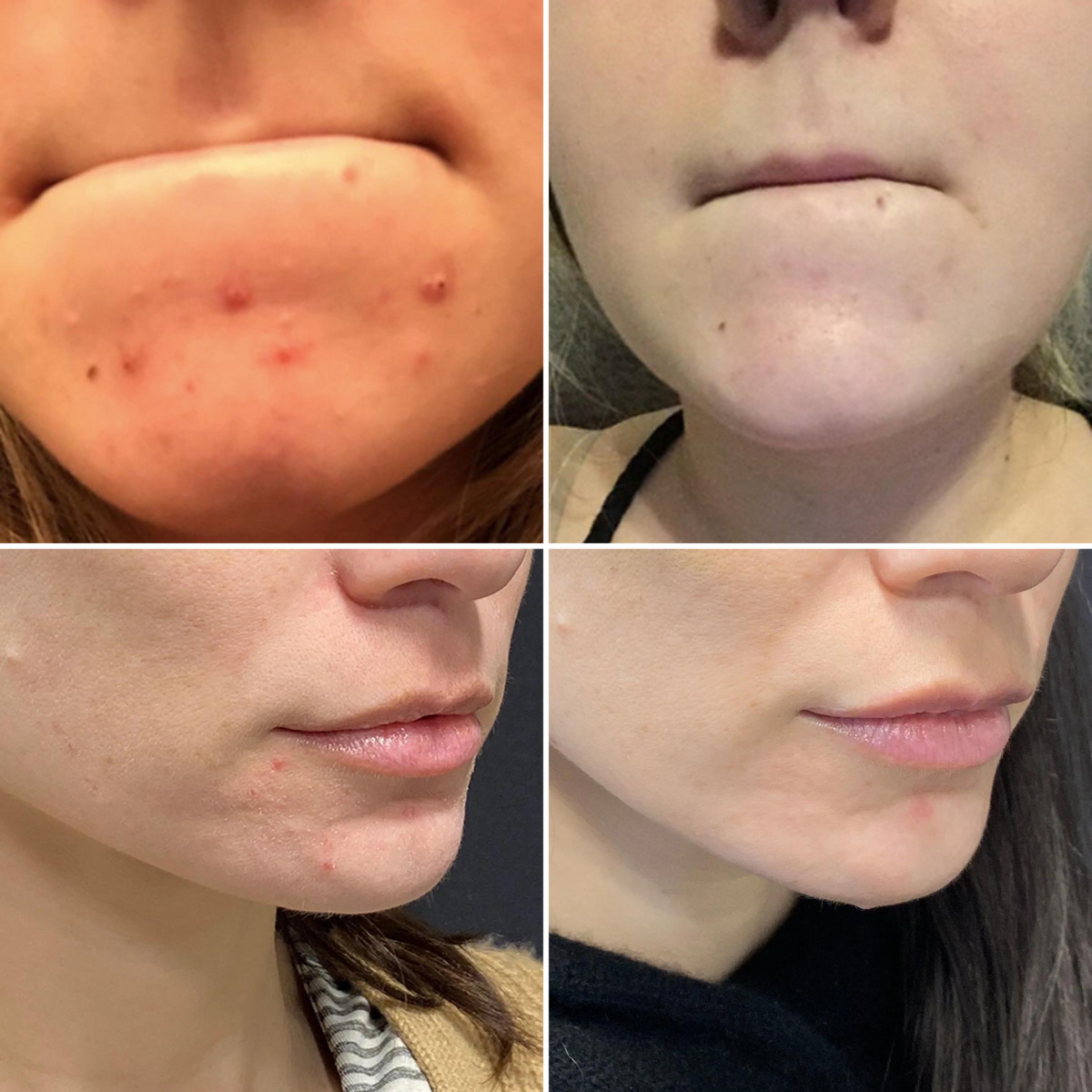 Glotech™ Acne Wand