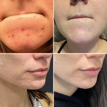 Glotech™ Acne Wand