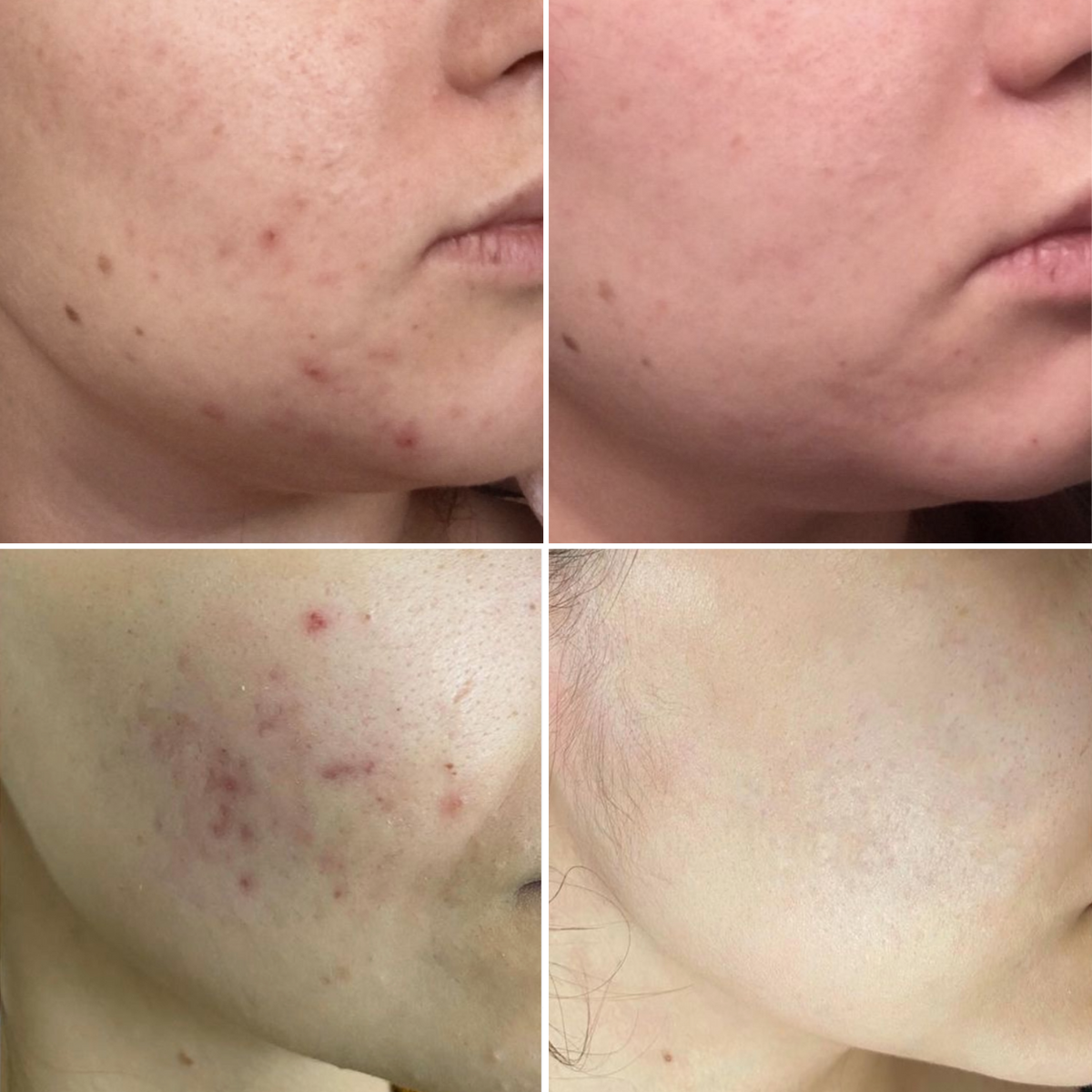 Glotech™ Acne Wand