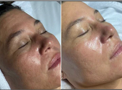 Iggie, 39 before and after using Instant hydration boost!