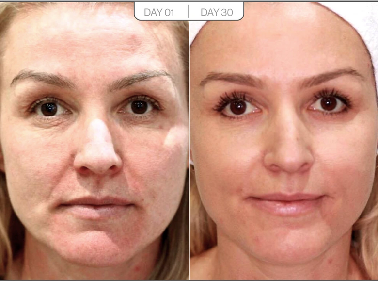 Lisa, 47 before and after using Better than laser
