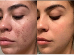 Adriana, 38 before and after using Bright, even skin!
