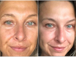 Katrina, 42 before and after using Wrinkles reduced!