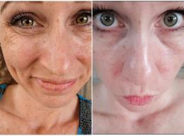 Jessica, 39 before and after using Gentle, no irritation
