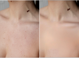 Adriana, 38 before and after using My skin is glowing!