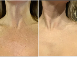 Veronica, 34 before and after using Bye bye dark spots