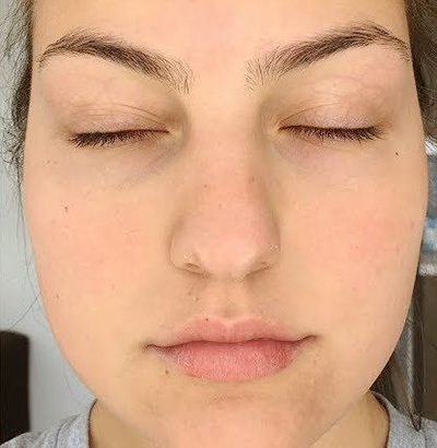 Client after using LED Esthetics