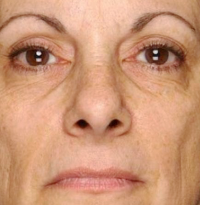 Client before using LED Esthetics