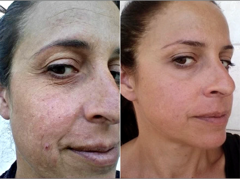 Jessie, 45 before and after using Years younger
