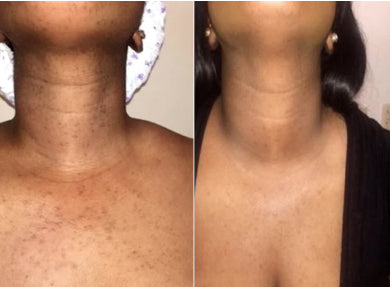 Grace, 46 before and after using Total chest makeover