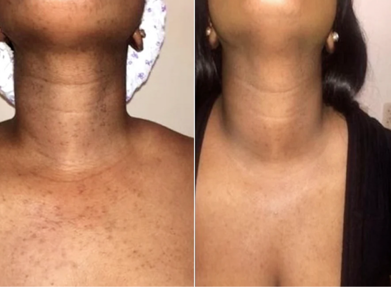 Grace, 46 before and after using Total chest makeover