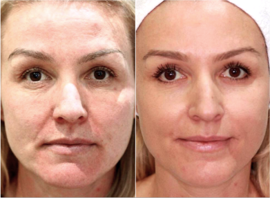 Lisa, 47 before and after using Better than laser