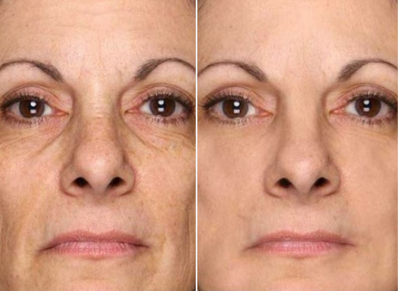 Marge, 68 before and after using Worth the money