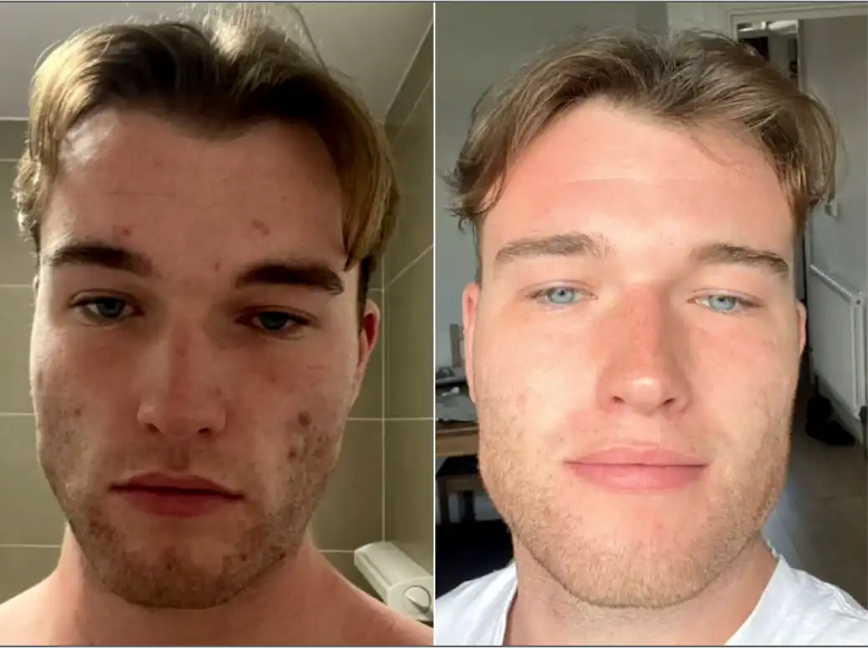 Tyler, 29 before and after using It really works
