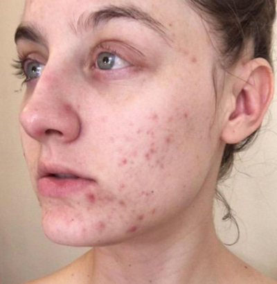 Client before using LED Esthetics