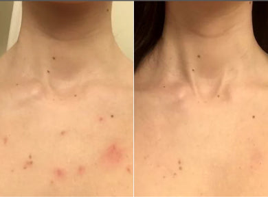 Kelli, 29 before and after using Finally clear skin