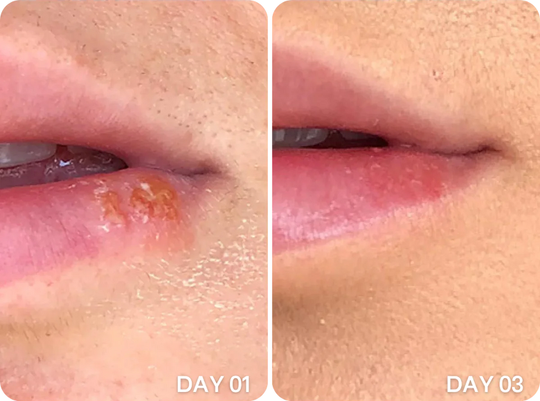 Sarah, 34 before and after using Gone in 3 days