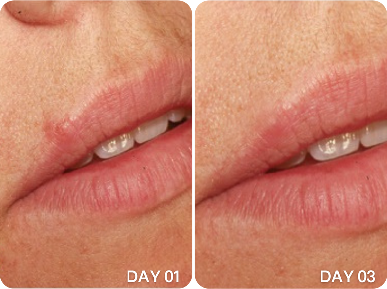 Monica, 52 before and after using Less pain, faster healing