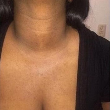 Grace, 46 after using LED Esthetics