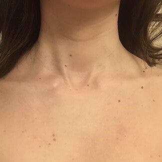 Kelli, 29 after using LED Esthetics
