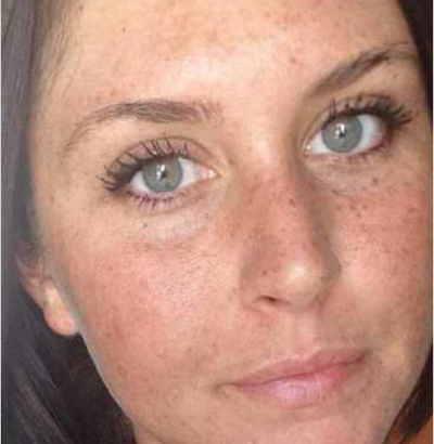 Client before using LED Esthetics